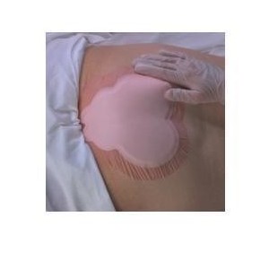 Medicazione idrocellulare adesiva sterile conformata per laregione sacrale assorbente in schiuma di poliuretano allevynsacrum 22