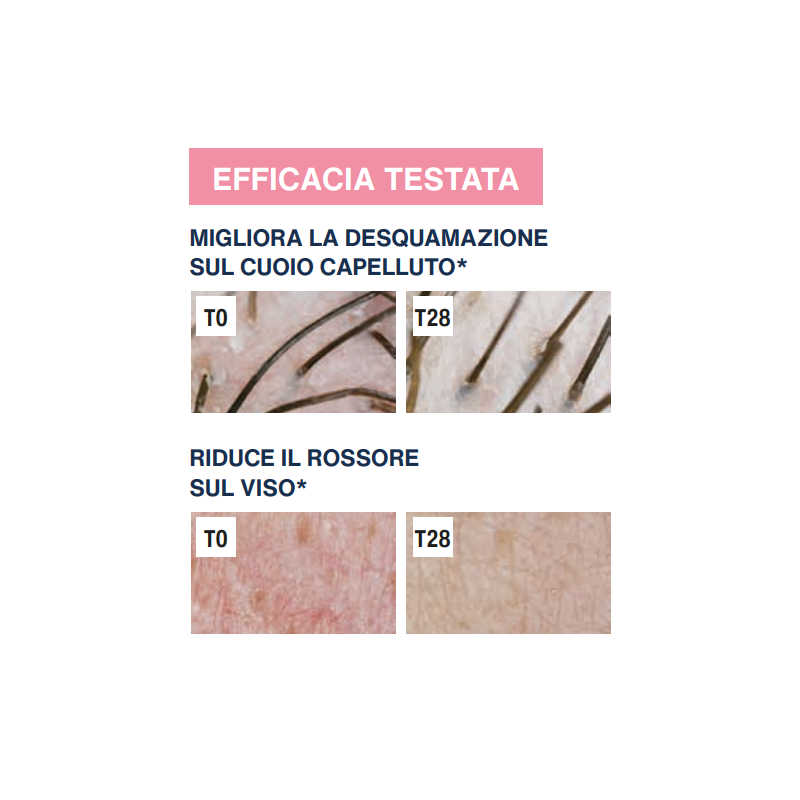 Rilastil difesa dermatite seborroica gel lenitivo sebonormalizzante 30 ml Rilastil difesa dermatite seborroica gel lenitivo sebonormalizzante 30 ml